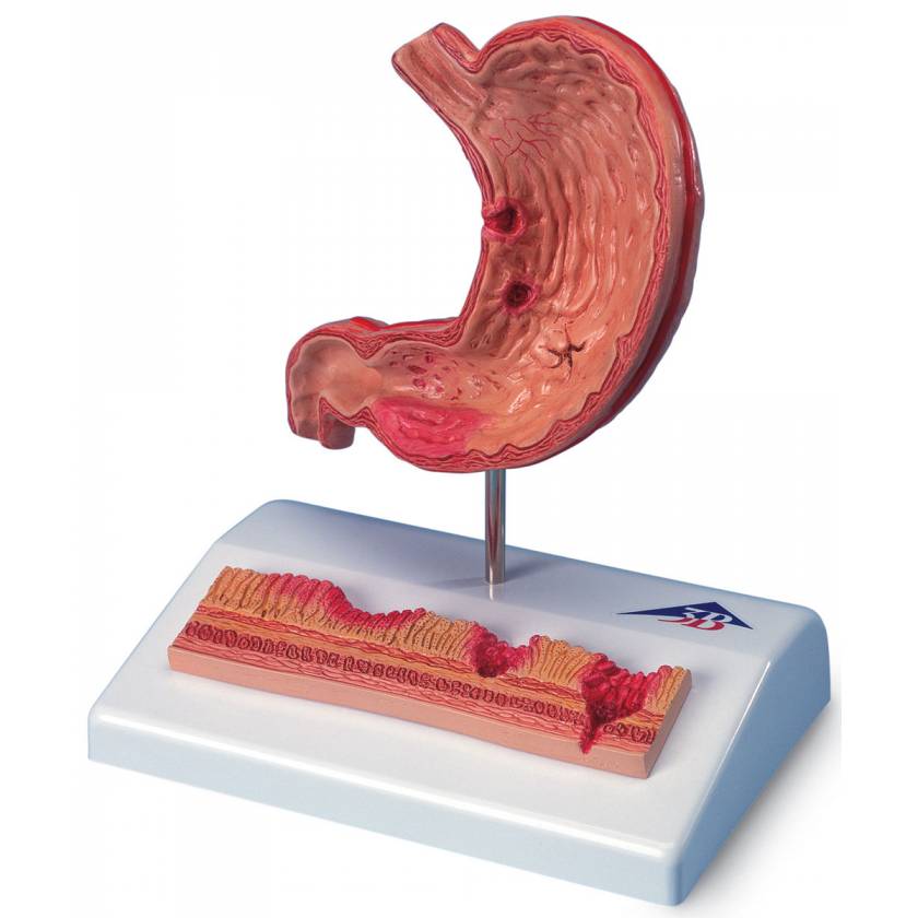 Stomach Model with Ulcers