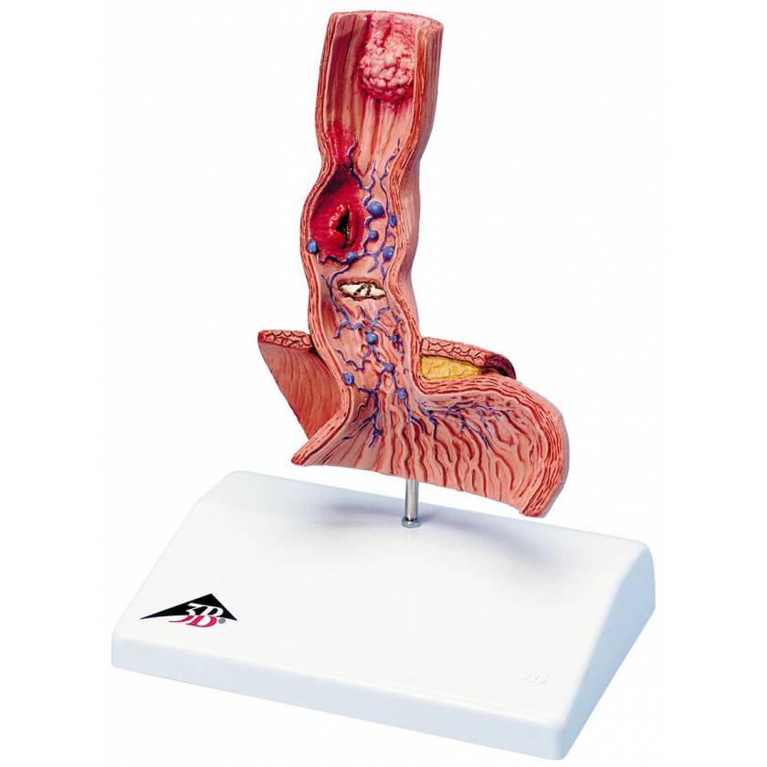 Diseases of the Esophagus Model