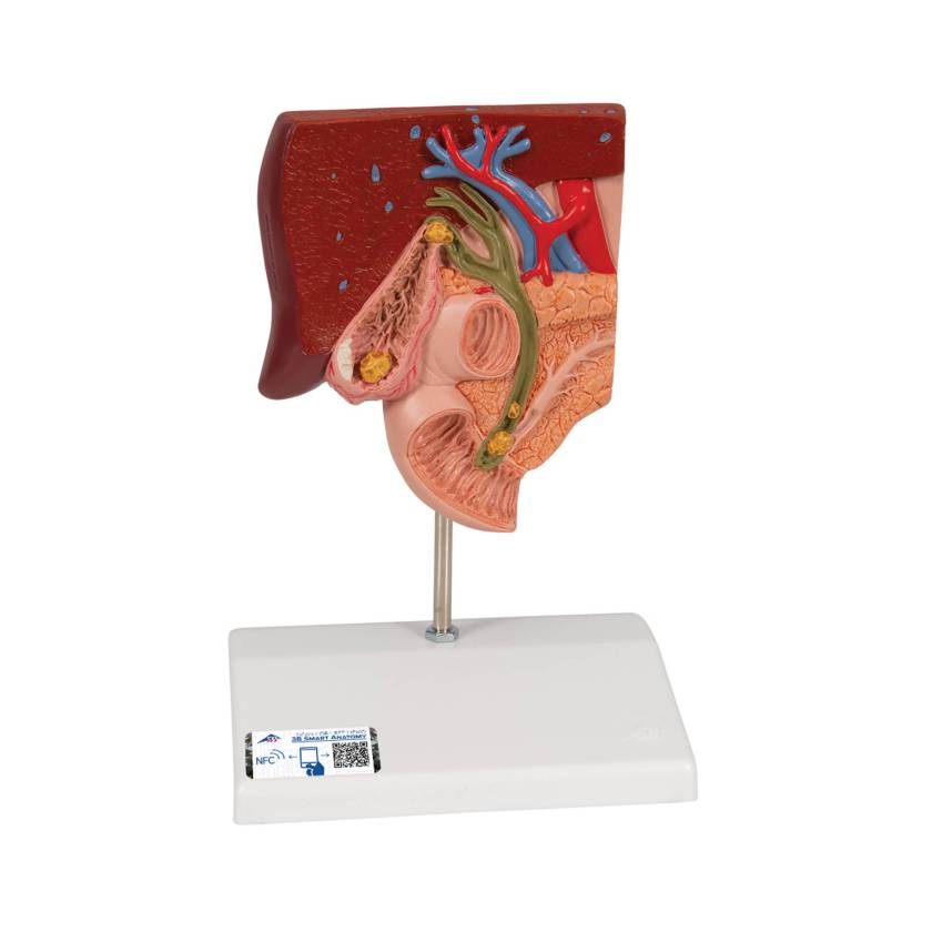 3B Scientific K26 Gallstone Model