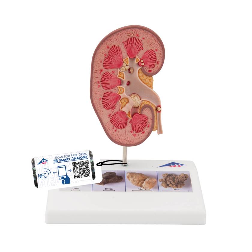 3B Scientific K29 Kidney Stone Model - 3B Smart Anatomy