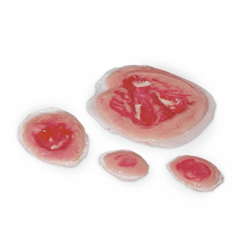 Life/form Moulage Wound - Pressure Ulcers Simulator - Set of 4