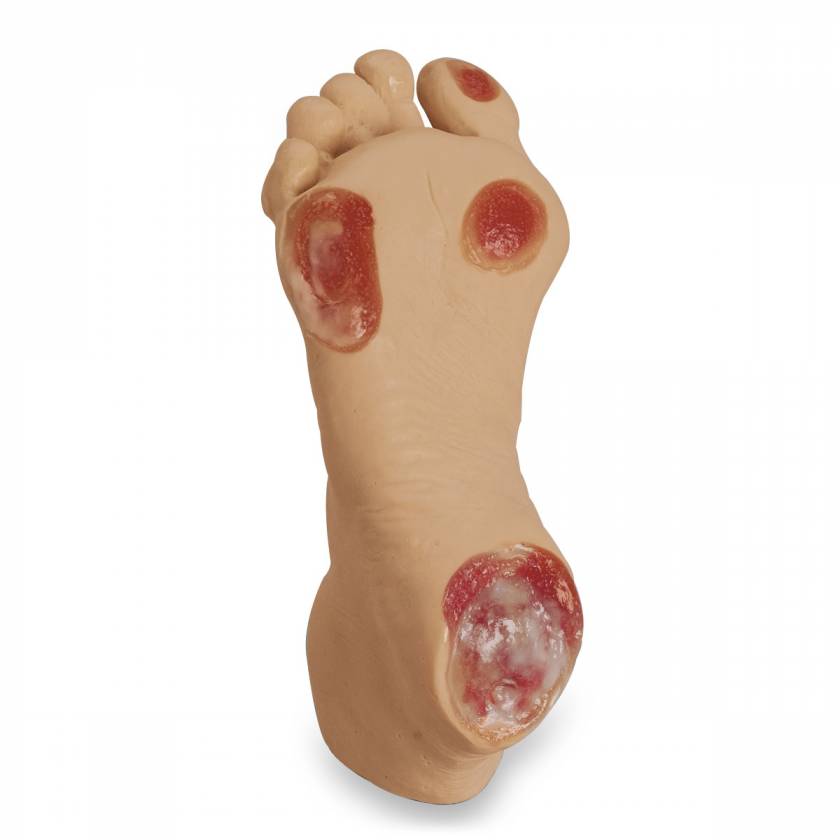 Life/form Elderly Pressure Ulcer Foot - Light