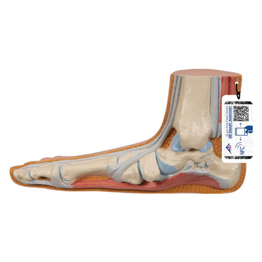 3B Scientific M31 Flat Foot (Pes Planus) Model - Light Skin Tone