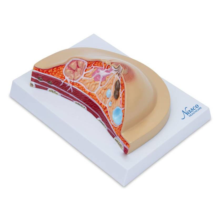 Nasco MG17229 Breast Cross-Section with Pathologies Model - Left Angle