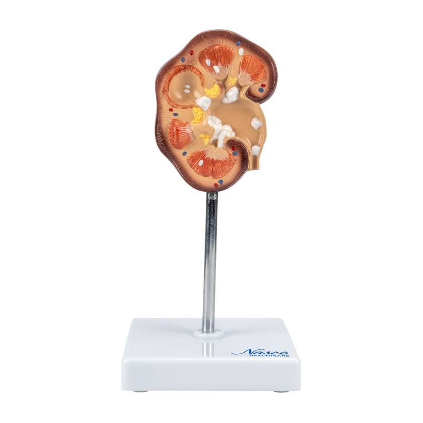 Nasco MG21415 Kidney Stone Model - Front View