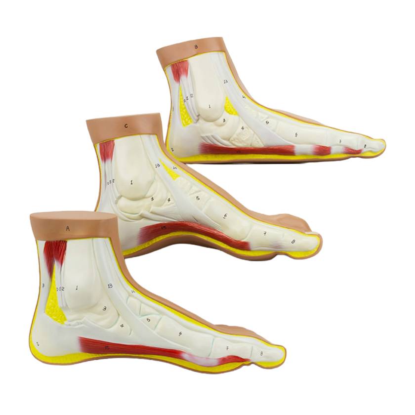 Nasco MG22042 Normal and Abnormal Foot Model, Set of 3, Left Side View