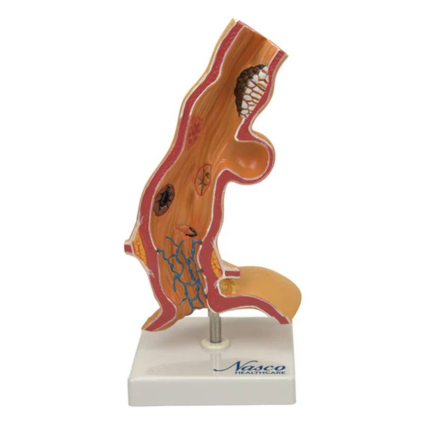 Nasco MG22729 Esophageal Disease Model, 5x Enlarged - Front View