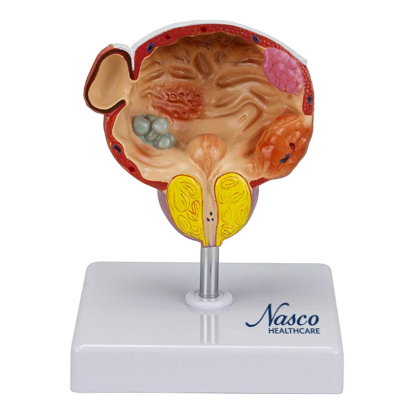 Nasco MG22730 Bladder and Prostate Diseases Model - Front View