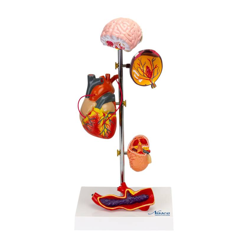Nasco MG22747 Effects of Arterial Hypertension Pathology Model, 5-Part