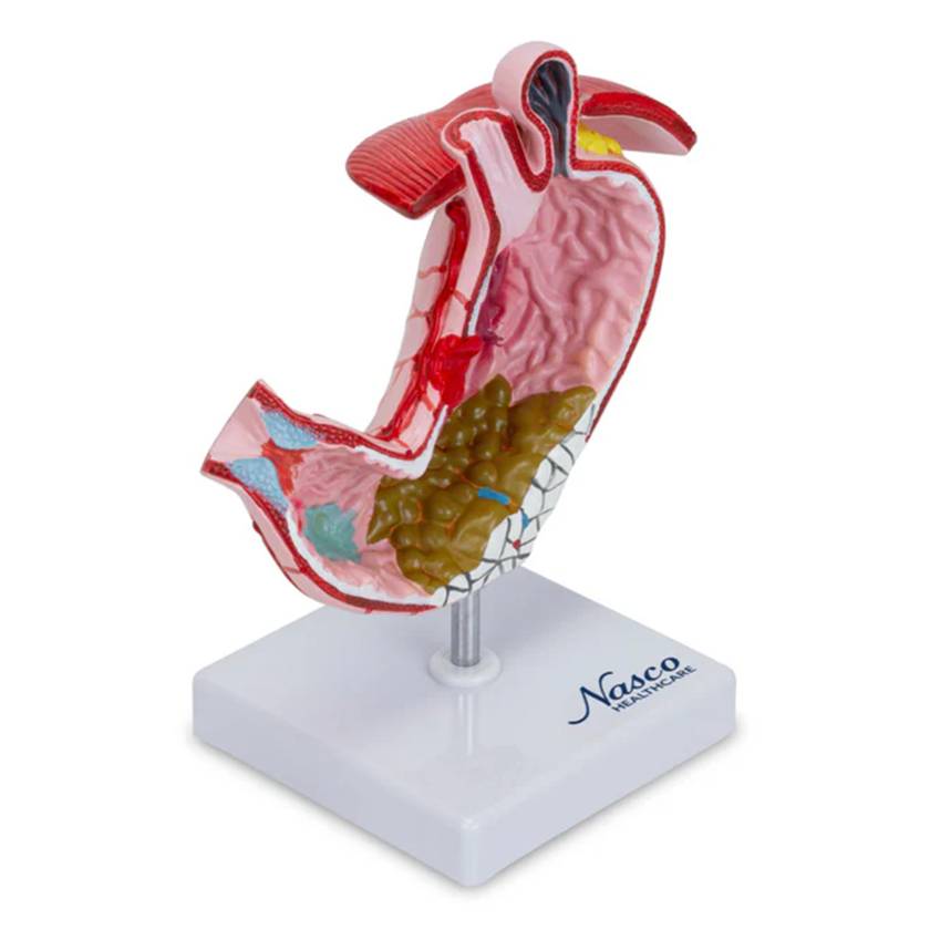 Nasco MG23162 Stomach with Gastric Ulcers Model - Right Angle