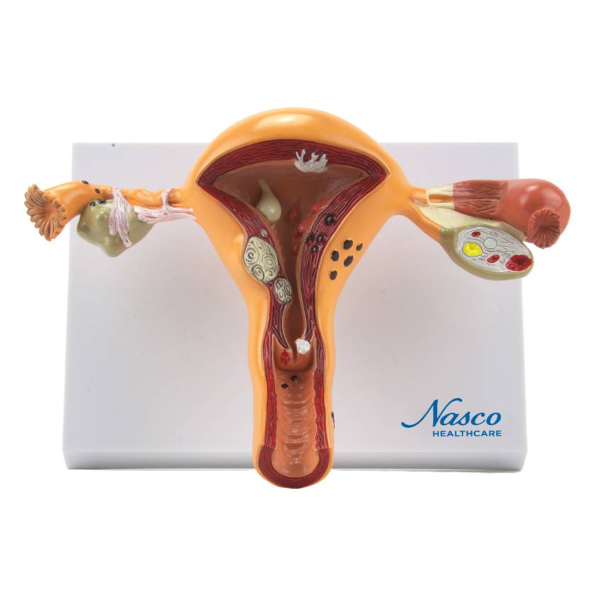 Nasco MG29789 Uterus and Ovary with Pathologies Model