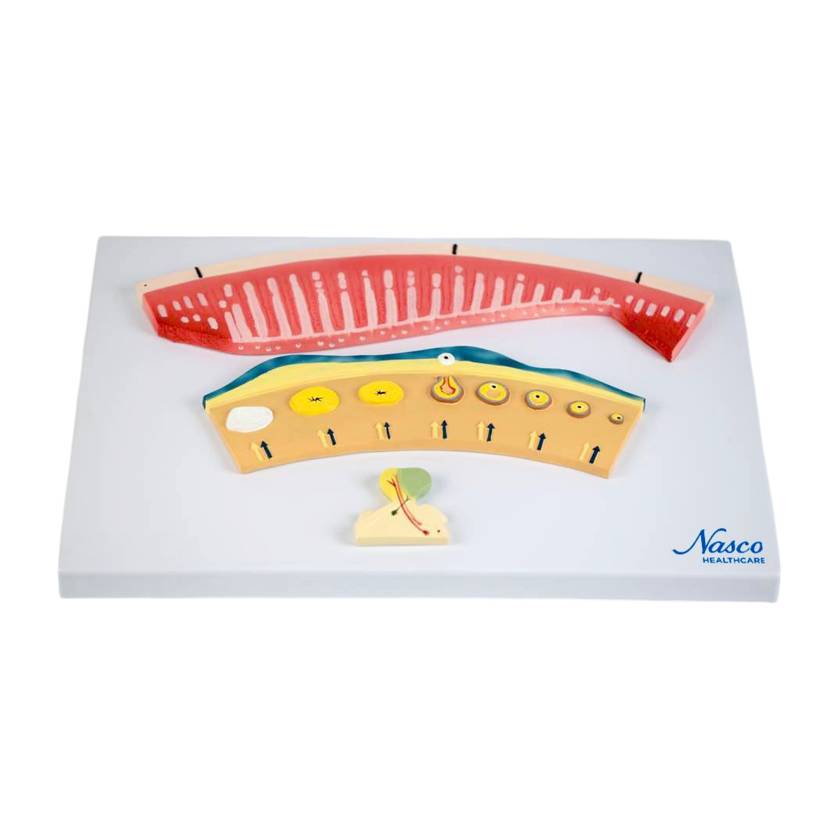 Nasco MG29725 Thyroid with Pathology Model, 4 Parts