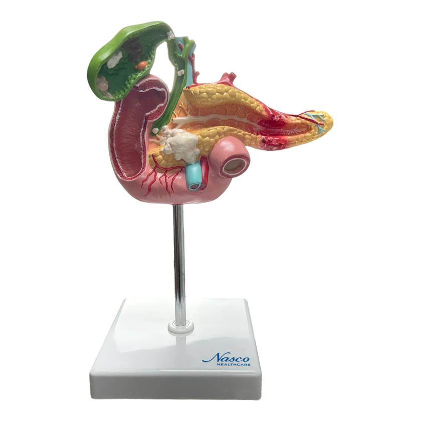 Nasco MG30031 Pancreas, Duodenum, and Gallbladder with Pathologies Model - Front View