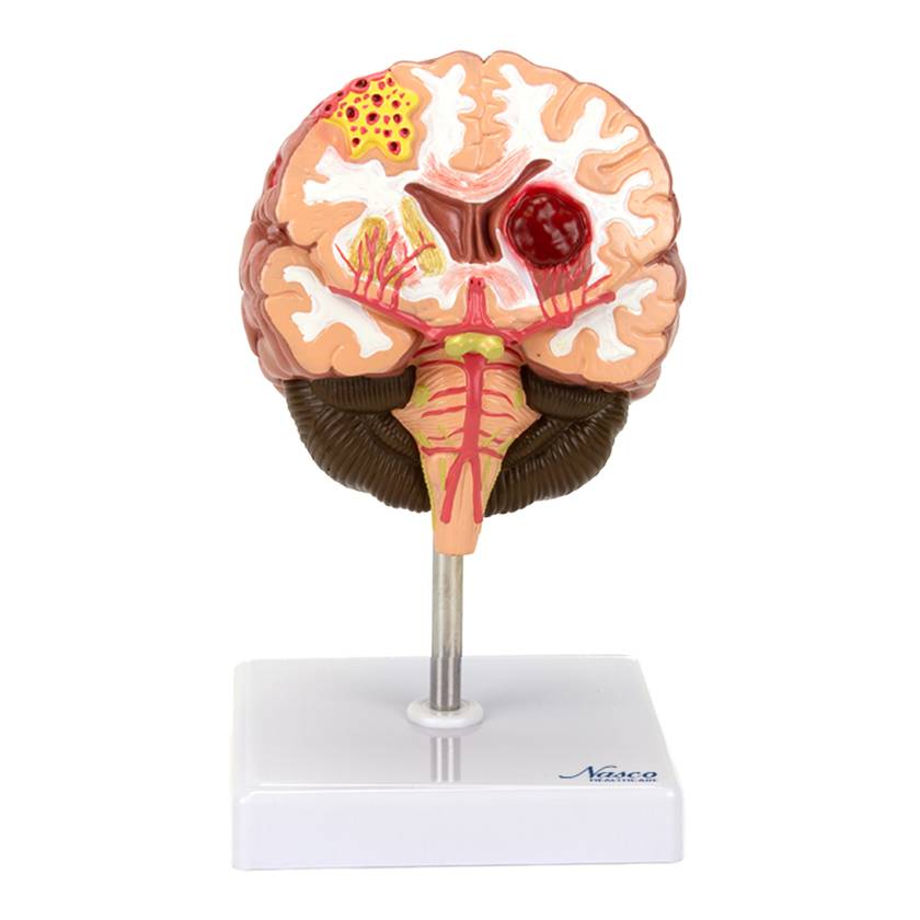 Nasco MG31100 Brain Section with Pathology Model - Angle 1