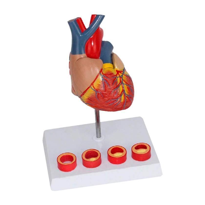 Nasco MG35530 Heart with Arteriosclerosis Model