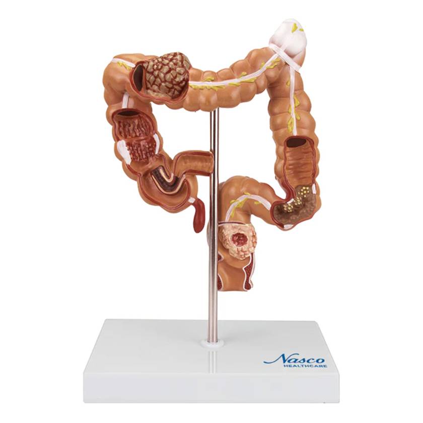 Nasco MG35589 Colon and Rectum with Intestinal Pathologies Model - Front View