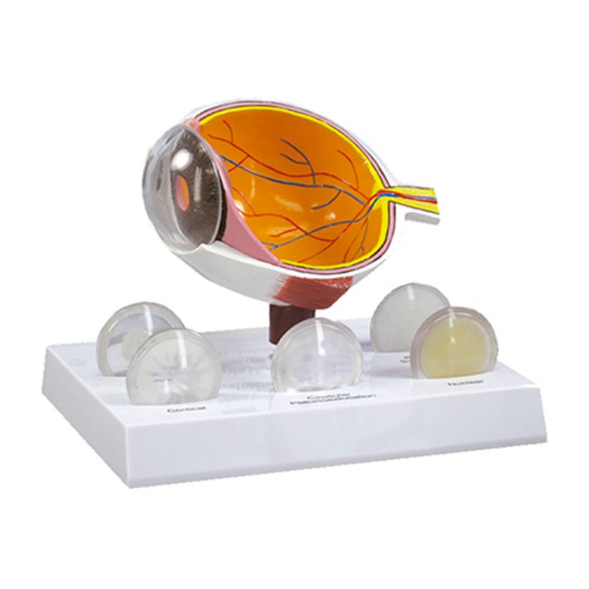Nasco MG38396 Eye with Cataract Model