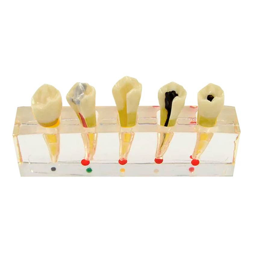 Nasco MG39443 Endodontics Dental Model, 5 Parts - Front View