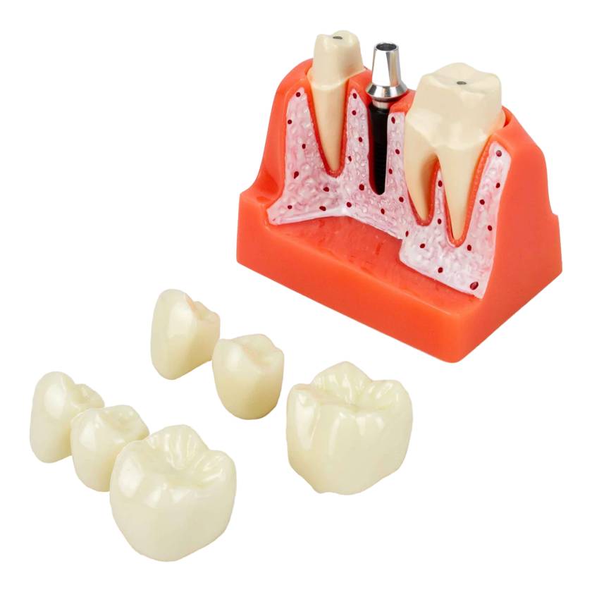 Nasco MG39444 Dental Implant Model, 8 Parts - Angle 1