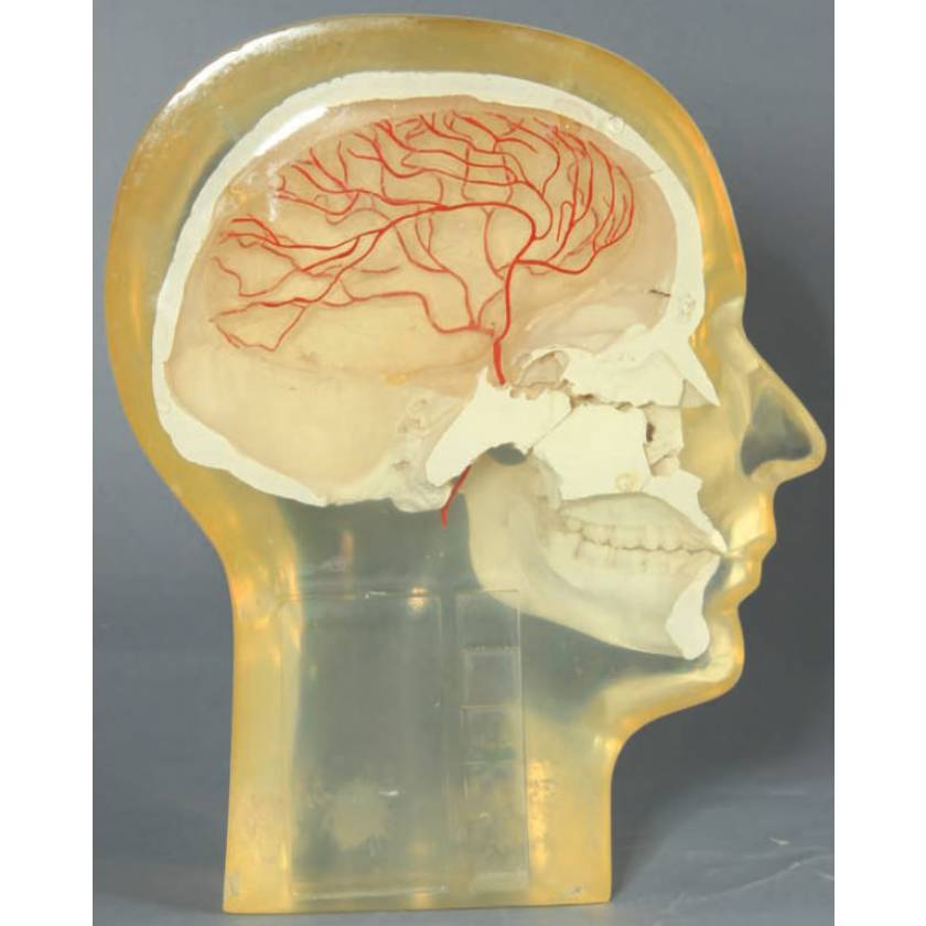 RSD Anthropomorphic Half Angiographic Head Phantom with Step Wedge