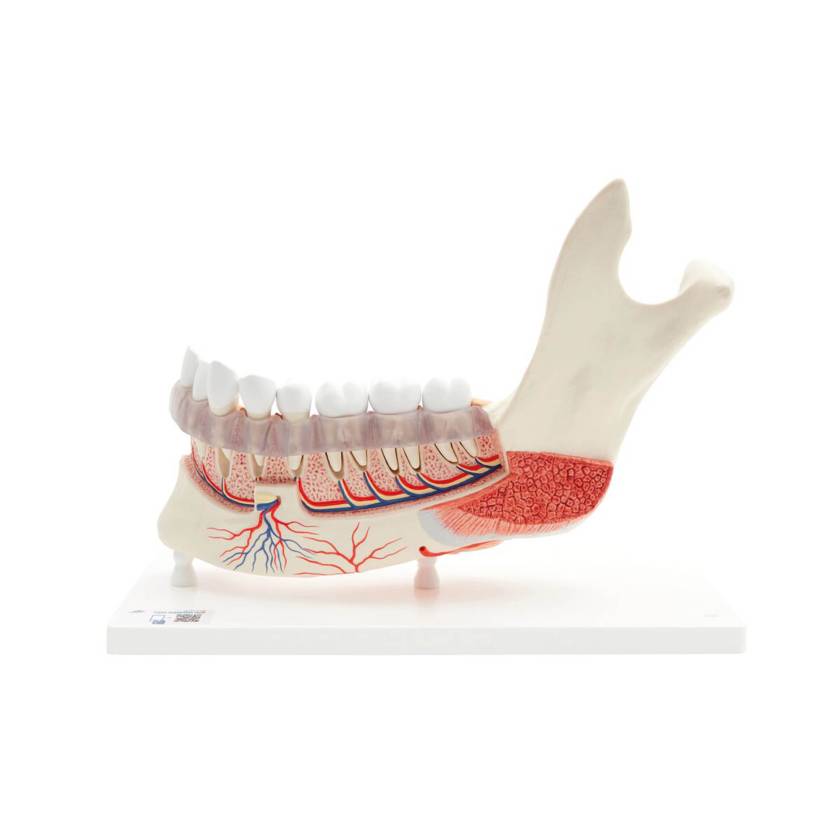 3B Scientific VE290 Advanced Half Lower Jaw with 8 Diseased Teeth 19-Part - 3B Smart Anatomy