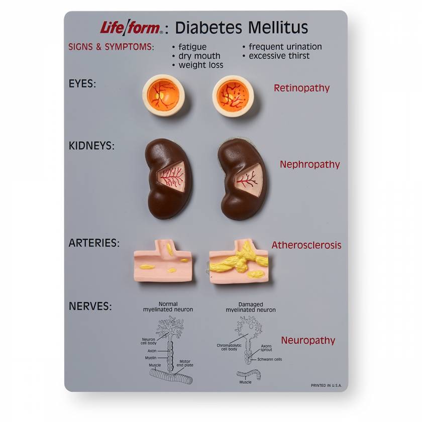 Life/form Diabetes Mellitus Teaching Kit