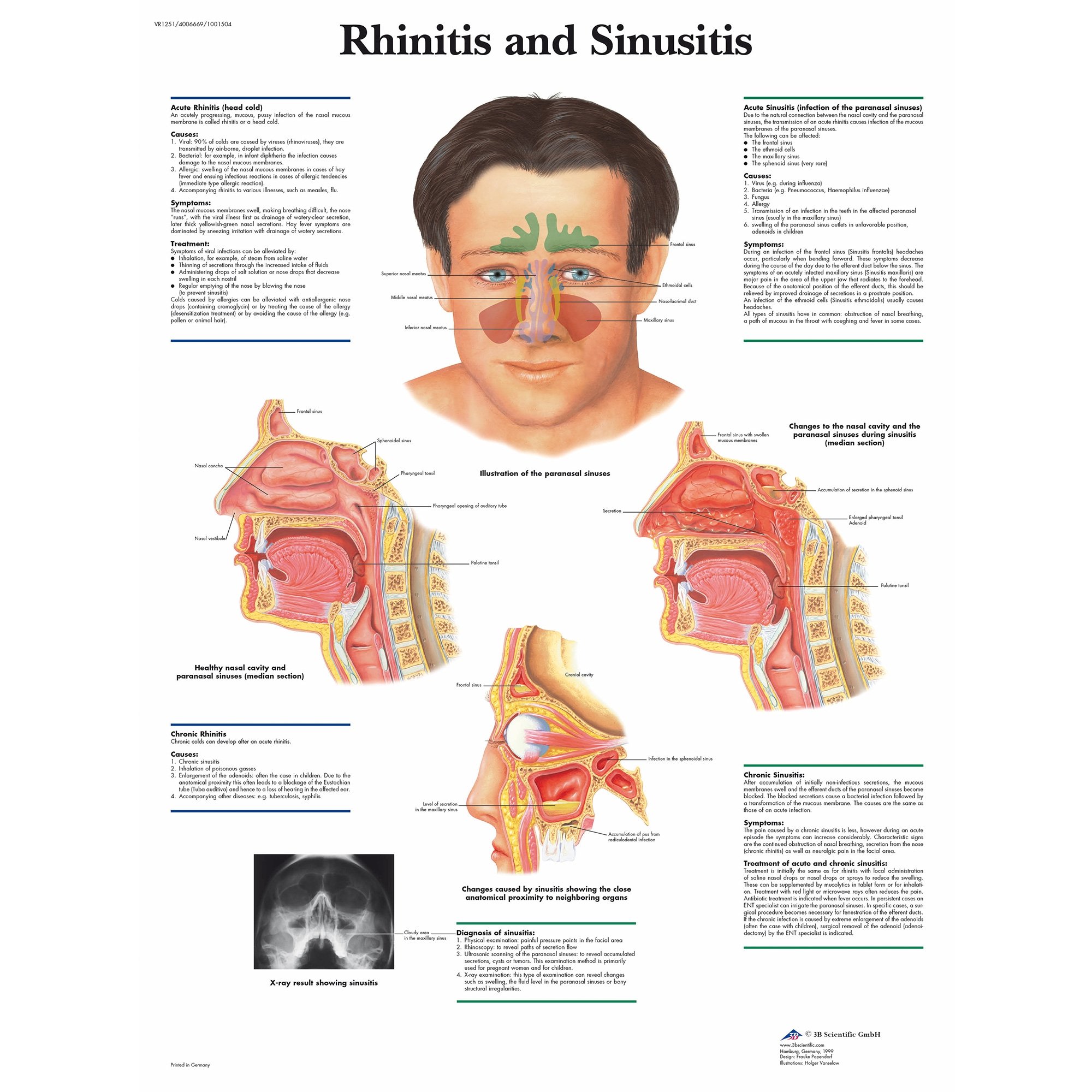3b Scientific Rhinitis And Sinusitis Chart