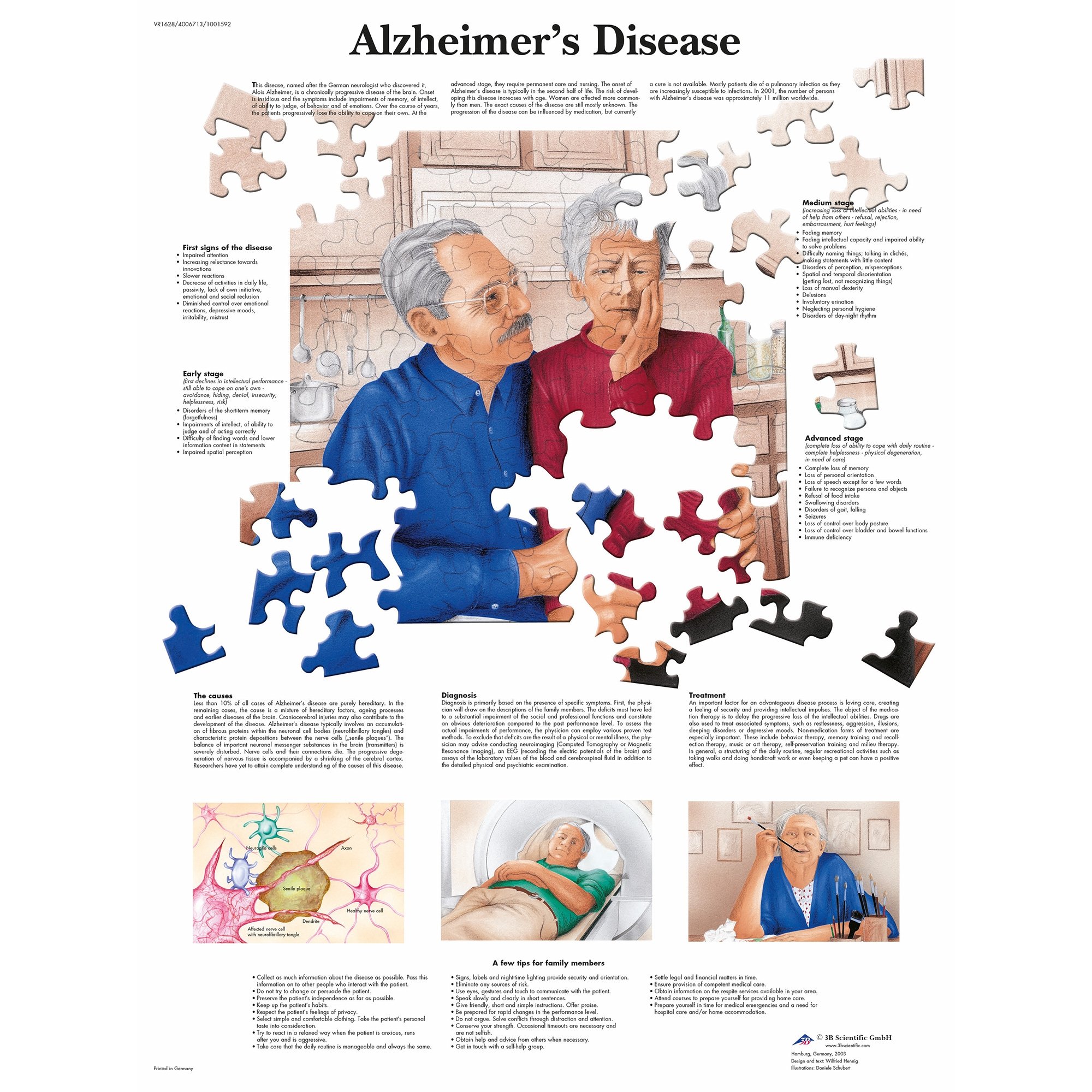 Alzheimers Stages Chart