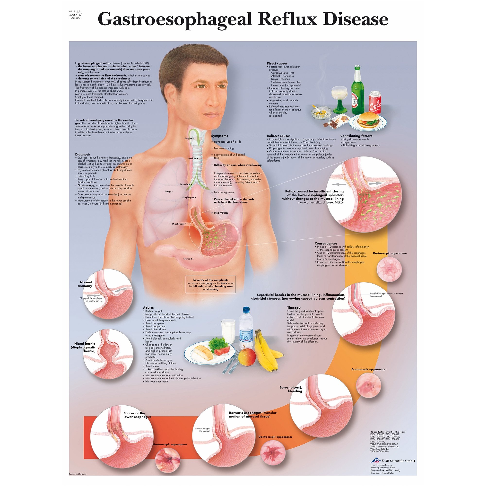 Acid Reflux Diagram