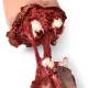 Simulaids Xtreme Trauma Bleeding Leg Moulage for STAT Simulators