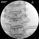 3B Scientific 1021900 Image Guided Cervical Spine Injection Trainer, Cervical Fluoroscopy Interlaminar Epidural