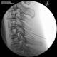 3B Scientific 1021900 Image Guided Cervical Spine Injection Trainer, Cervical Fluoroscopy Interlaminar Epidural Lateral View