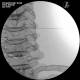 3B Scientific 1021900 Image Guided Cervical Spine Injection Trainer, Cervical Fluoroscopy Intraarticular Facet from Lateral AP View
