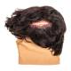 STOPS Medical 1025990 Lacerated Scalp Hood with Hair - Light Skin Tone