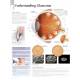 Understanding Glaucoma Chart