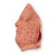 Life/form Moulage Wound - Smallpox, 2nd Day, Face Simulator