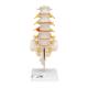3B Scientific A76/5 Human Lumbar Spinal Column Model with Dorso-Lateral Prolapsed Intervertebral Disc - 3B Smart Anatomy