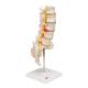 3B Scientific A76/5 Human Lumbar Spinal Column Model with Dorso-Lateral Prolapsed Intervertebral Disc - 3B Smart Anatomy