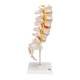 3B Scientific A76/5 Human Lumbar Spinal Column Model with Dorso-Lateral Prolapsed Intervertebral Disc - 3B Smart Anatomy