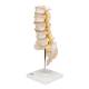 3B Scientific A76/5 Human Lumbar Spinal Column Model with Dorso-Lateral Prolapsed Intervertebral Disc - 3B Smart Anatomy