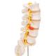 3B Scientific A76/5 Human Lumbar Spinal Column Model with Dorso-Lateral Prolapsed Intervertebral Disc - 3B Smart Anatomy