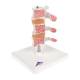 3B Scientific A78 Deluxe Osteoporosis Model (3 Vertebrae) - 3B Smart Anatomy