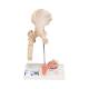 3B Scientific A88 Femoral Fracture and Hip Osteoarthritis Model - 3B Smart Anatomy
