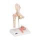 3B Scientific A88 Femoral Fracture and Hip Osteoarthritis Model - 3B Smart Anatomy