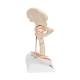 3B Scientific A88 Femoral Fracture and Hip Osteoarthritis Model - 3B Smart Anatomy