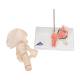 3B Scientific A88 Femoral Fracture and Hip Osteoarthritis Model - 3B Smart Anatomy