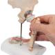 3B Scientific A88 Femoral Fracture and Hip Osteoarthritis Model - 3B Smart Anatomy