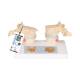 3B Scientific A95 Osteoporosis Model - 3B Smart Anatomy