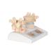 3B Scientific A95 Osteoporosis Model - 3B Smart Anatomy