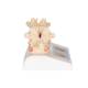 3B Scientific A95 Osteoporosis Model - 3B Smart Anatomy